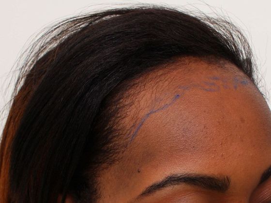 Hair Transplant - Female: Traction Alopecia (6) - Before traction alopecia