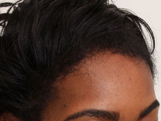 Hair Transplant - Female: Traction Alopecia (6) - After traction alopecia hair transplant