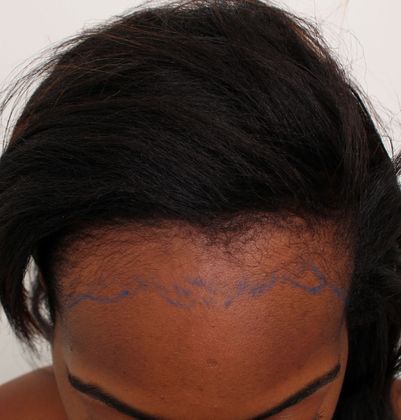 Hair Transplant - Female: Traction Alopecia (6) - Before traction alopecia
