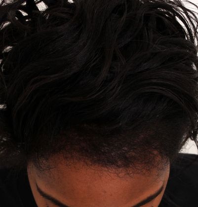 Hair Transplant - Female: Traction Alopecia (6) - After traction alopecia hair transplant