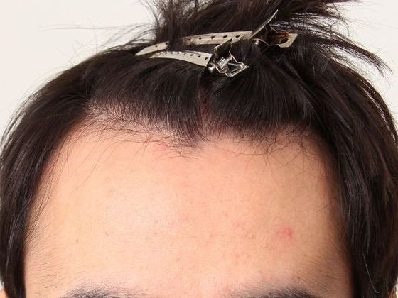 Male Before And After Hair Transplant Photos Hairline FUE (12) - Before