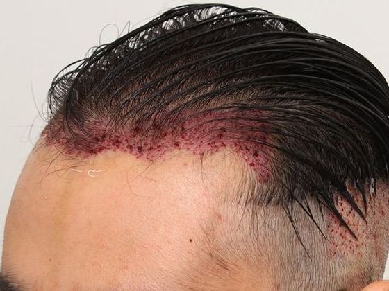 Hair Transplant - Male: Hairline FUE - Case 12 - Post-op FUE hair transplant