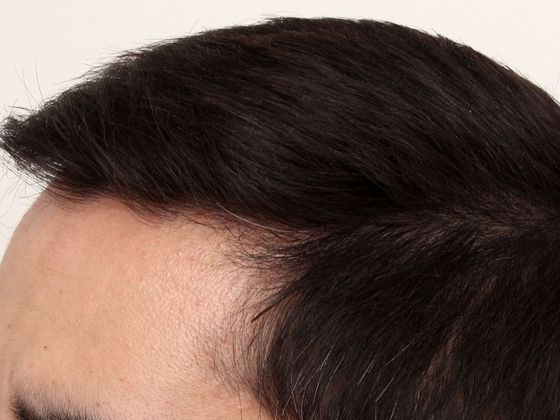 Hair Transplant - Male: Hairline FUE - Case 12 - After FUE hair transplant