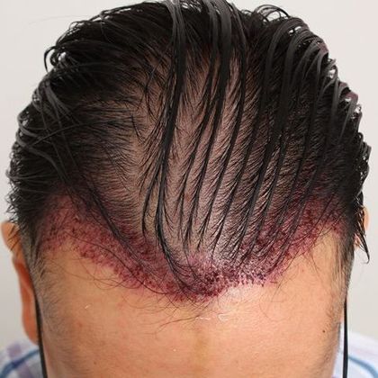 Hair Transplant - Male: Hairline FUE - Case 12 - Before FUE hair transplant