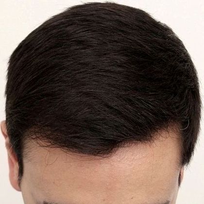 Hair Transplant - Male: Hairline FUE - Case 12 - After FUE hair transplant