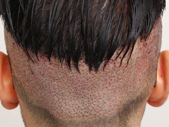 Hair Transplant - Male: Hairline FUE - Case 12 - Post-op FUE hair transplant