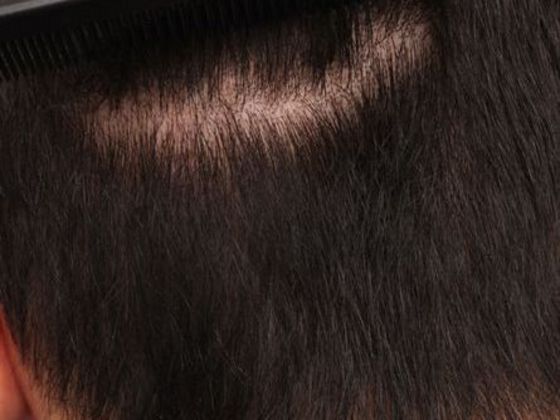 Hair Transplant - Male: Hairline FUE - Case 12 - Donor area after FUE