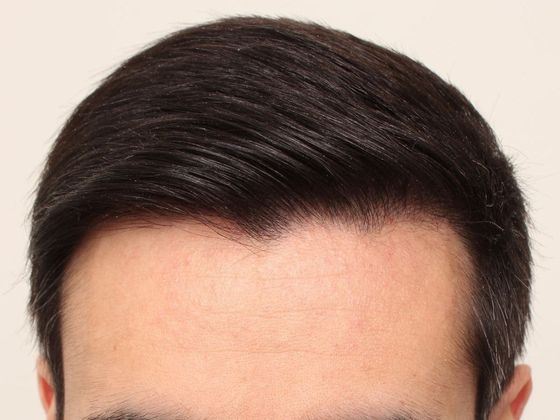 Male Before And After Hair Transplant Photos Hairline FUE (12) - After