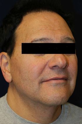 Neck Sculpting : Case 5 - After