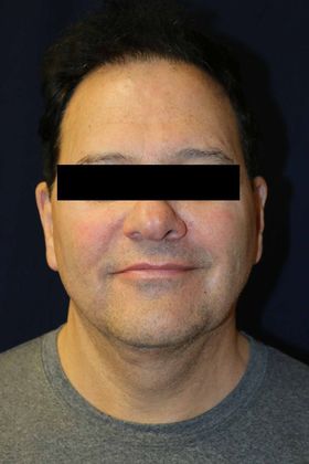 Neck Sculpting : Case 5 - After