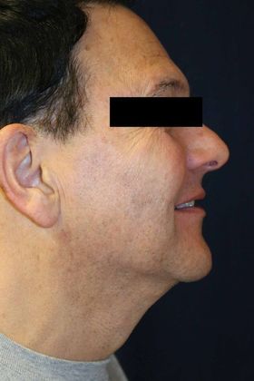 Neck Sculpting : Case 5 - After