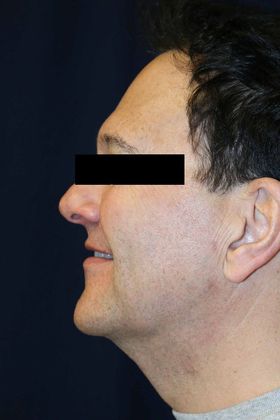 Neck Sculpting : Case 5 - After