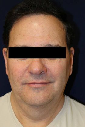 Neck Sculpting : Case 5 - Before