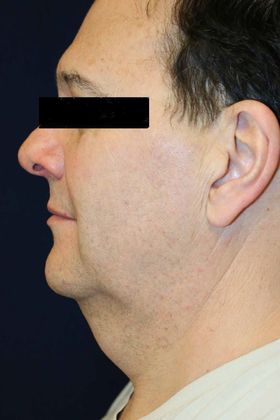 Neck Sculpting : Case 5 - Before