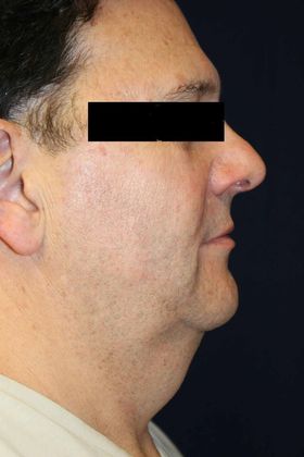 Neck Sculpting : Case 5 - Before