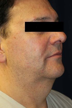 Neck Sculpting : Case 5 - Before