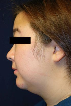Neck Sculpting : Case 4 - Before