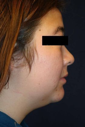 Neck Sculpting : Case 4 - Before