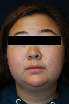 Neck Sculpting : Case 4 - After