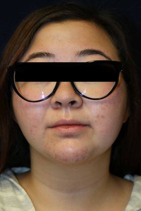 Neck Sculpting : Case 4 - After