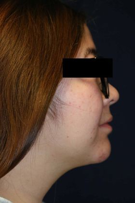 Neck Sculpting : Case 4 - After