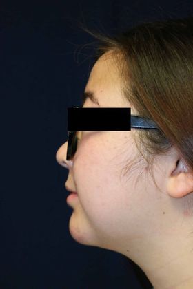 Neck Sculpting : Case 4 - After