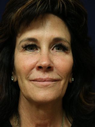 Potenza RF Microneedling : Case 1 - Before