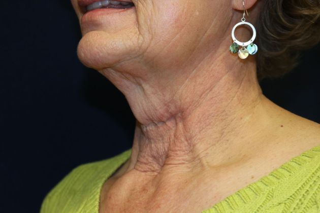 Neck Sculpting : Case 15 - Before