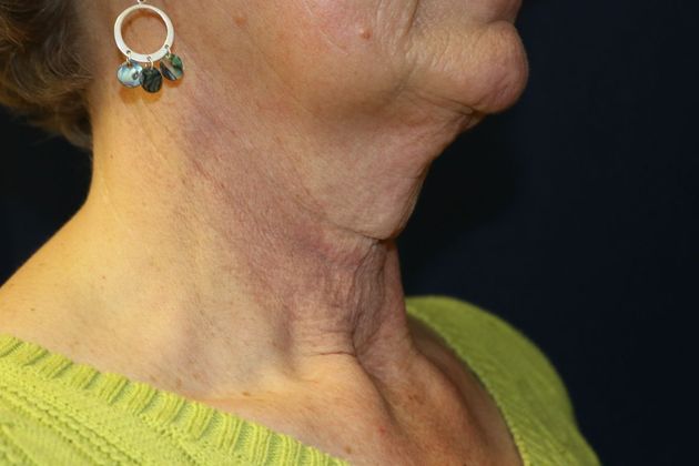 Neck Sculpting : Case 15 - Before