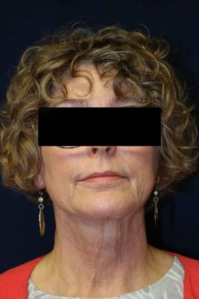 Neck Sculpting : Case 15 - After