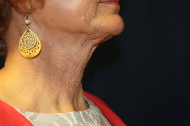 Neck Sculpting : Case 15 - After