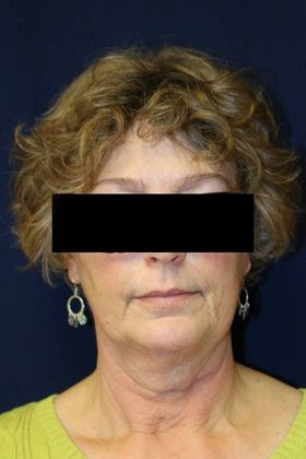 Neck Sculpting : Case 15 - Before