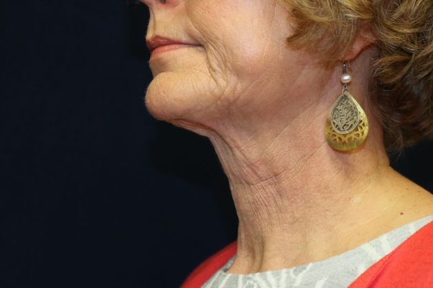 Neck Sculpting : Case 15 - After