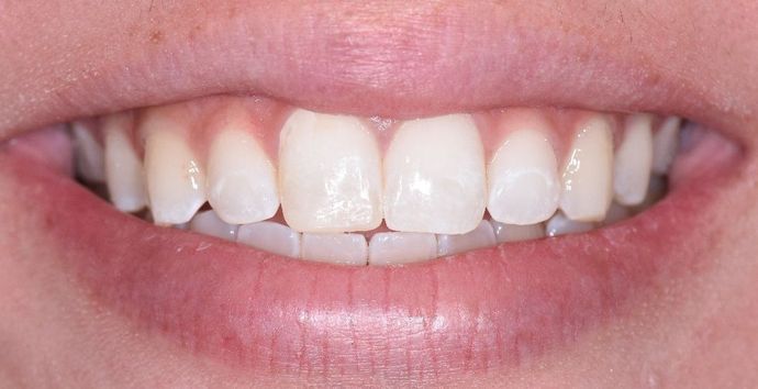 Tooth-colored Fillings Case 16 - Victoria, TX - Before