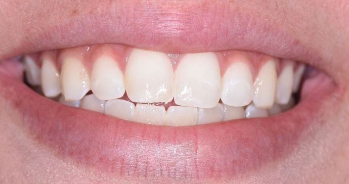 Tooth-colored Fillings Case 16 - Victoria, TX - After
