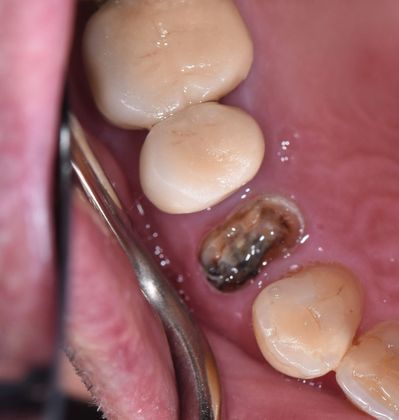Dental Implants Case 9 - Victoria, TX - Before