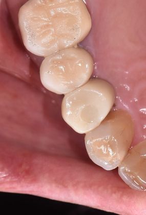 Dental Implants Case 9 - Victoria, TX - After