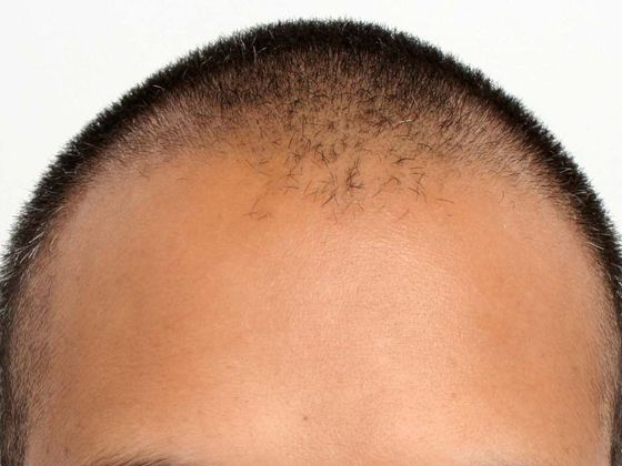 Male Before And After Hair Transplant Photos Hairline FUE (13) - Before