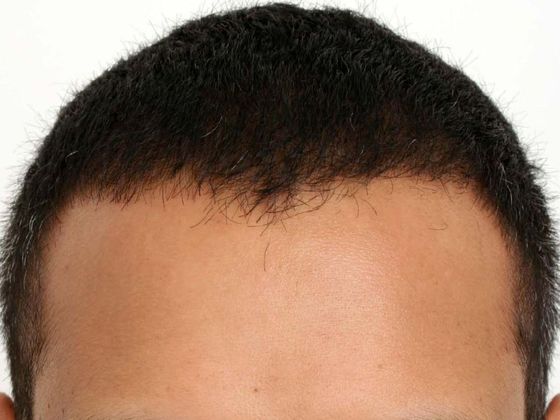 Male Before And After Hair Transplant Photos Hairline FUE (13) - After