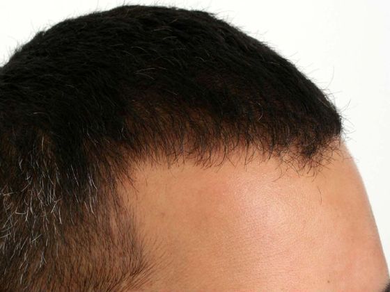 Hair Transplant - Male: Hairline FUE - Case 13 - After FUE hair transplant