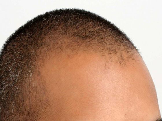 Hair Transplant - Male: Hairline FUE - Case 13 - Before FUE hair transplant