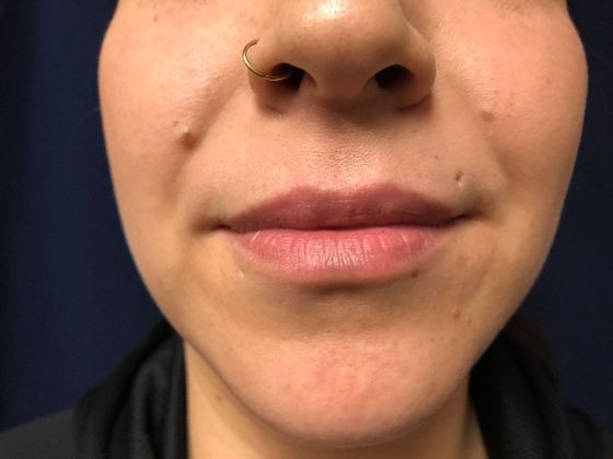 Cosmetic Injectables & Fillers*: Case 1 Lip Filler - Before