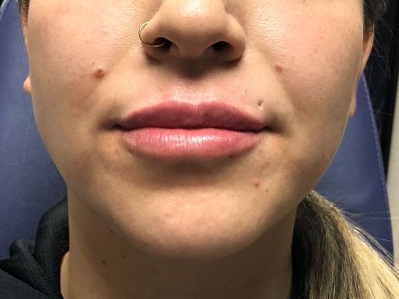 Cosmetic Injectables & Fillers*: Case 1 Lip Filler - After