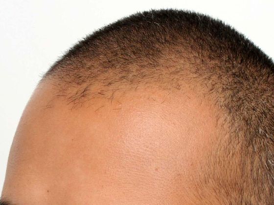 Hair Transplant - Male: Hairline FUE - Case 13 - Before FUE hair transplant