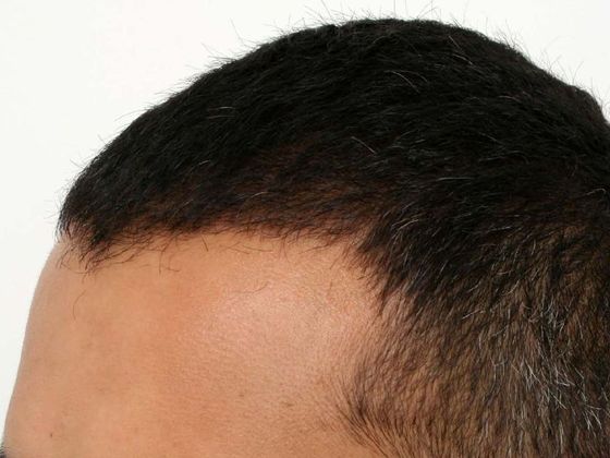 Hair Transplant - Male: Hairline FUE - Case 13 - After FUE hair transplant