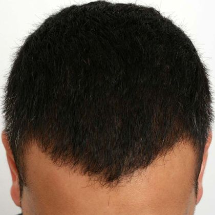 Hair Transplant - Male: Hairline FUE - Case 13 - After FUE hair transplant
