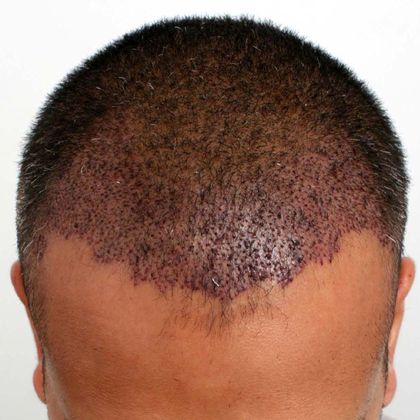 Hair Transplant - Male: Hairline FUE - Case 13 - Before FUE hair transplant