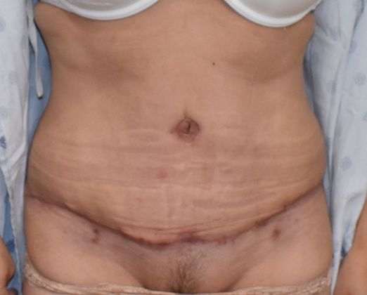 Tummy Tuck (Abdominoplasty): Case 267 - After