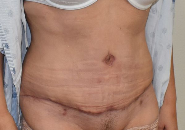 Tummy Tuck (Abdominoplasty): Case 267 - After