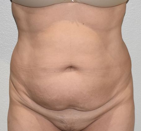 Tummy Tuck (Abdominoplasty): Case 267 - Before